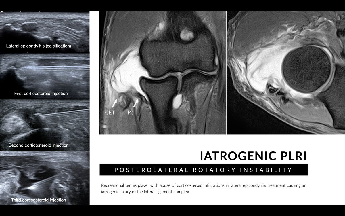 DmcRadiologia's tweet photo. Iatrogenic injury of the epicondylar insertion of the radial collateral and lateral ulnar collateral ligaments is a common complication in patients treated with corticosteroid infiltrations and secondary to lateral epicondylitis surgery (especially arthroscopic debridement) https://t.co/ydAkh2nAqc