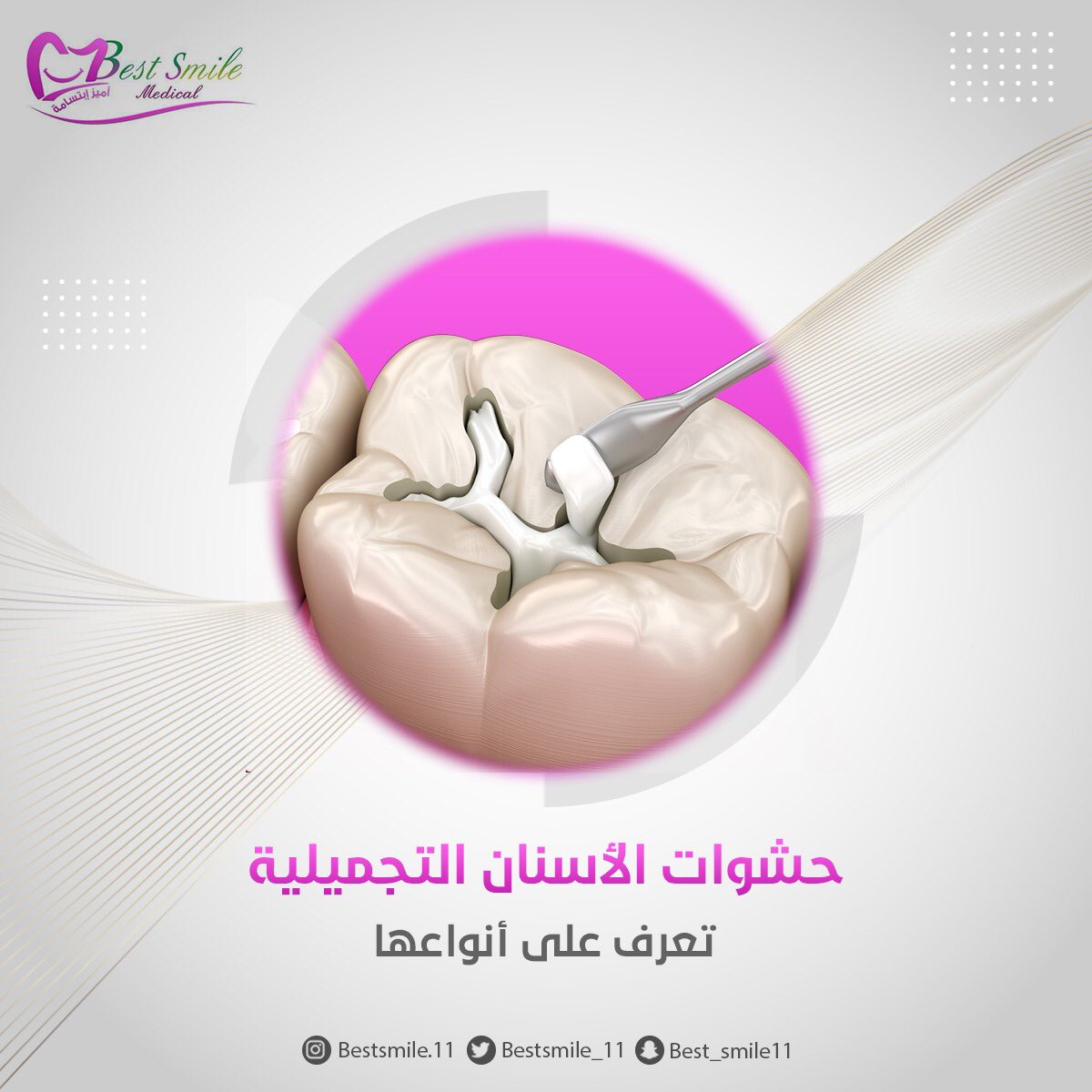 bestsmile_11's tweet photo. أنواع الحشوات التجميلية:
- الحشوات المركبة
 - حشوات السيراميك ( البورسلين) 
-حشوات الأيونومير الزجاجي
 - الحشوات المعدنية https://t.co/z7ZuCvAL43