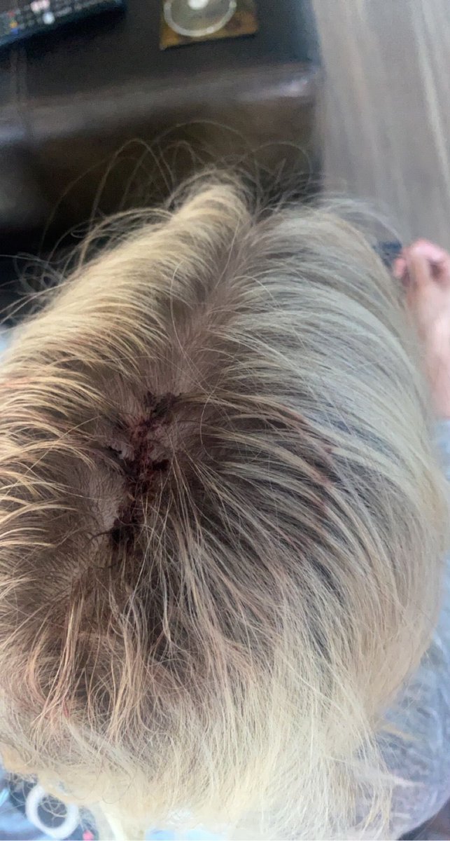 xxjen1984xx's tweet photo. Hopefully the last one to be removed π€π»#skincancer #pleasebeaware https://t.co/V6VKqrPj2V