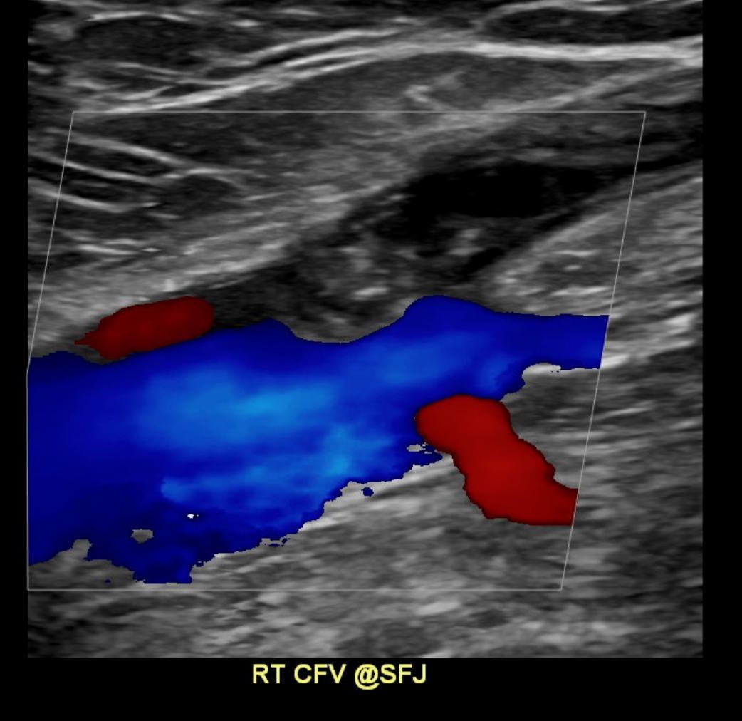 KhuranaBharti's tweet photo. Always assess the saphenofemoral junction to look for a greater saphenous vein (superficial) thrombosis that can propagate into the femoral vein (deep vein) #radres #MedTwitter #MedStudentTwitter #EDrad #EmergencyMedicine #ultrasound https://t.co/ZyKPxURjz7