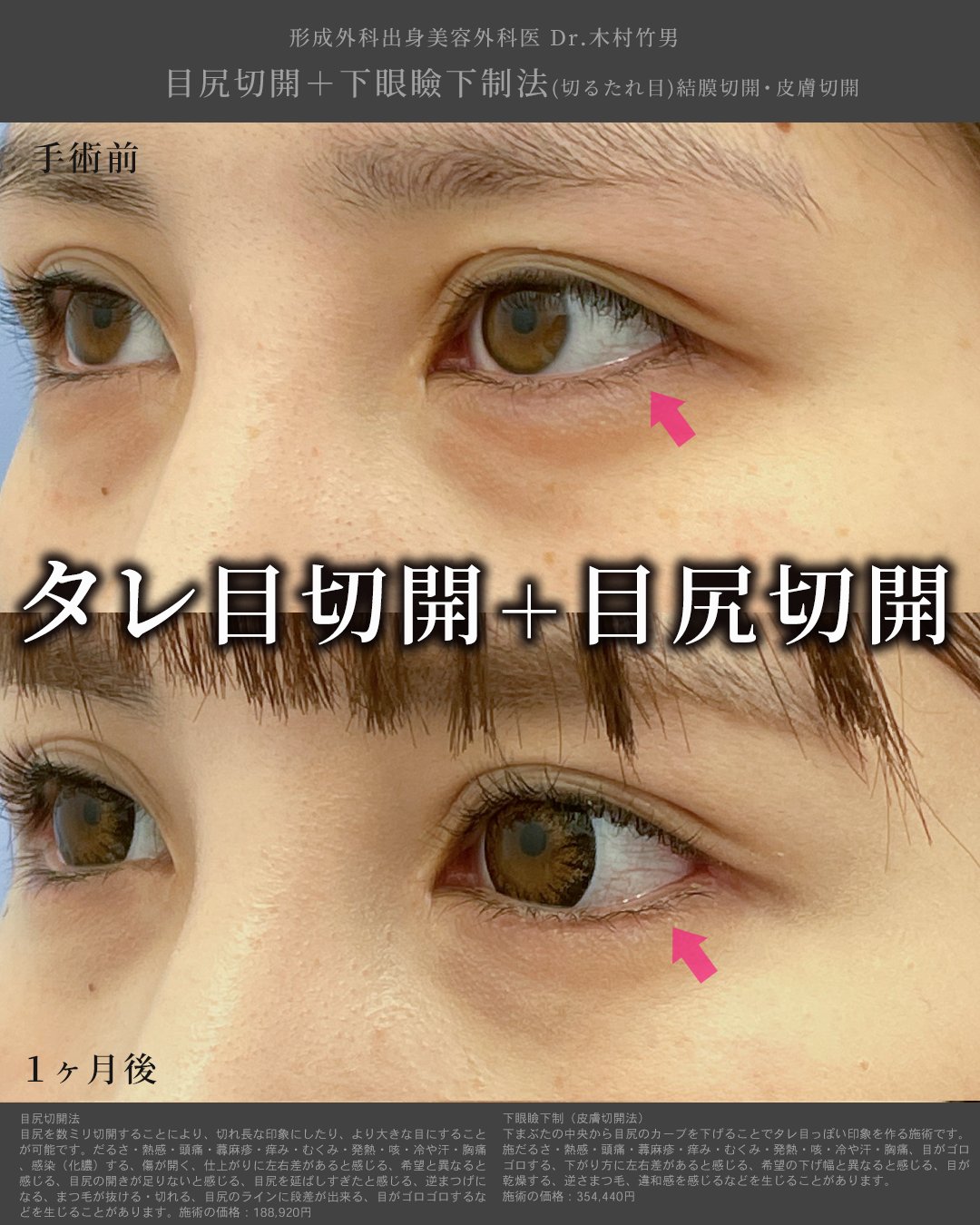 湘南美容クリニック武蔵小杉院 公式 タレ目形成 Sbc武蔵小杉院院長 木村竹男による タレ目切開 目尻切開 つり目 解消はもちろん 目を外側 下側に大きくすることが可能 なんだか垢抜けている メイク映えする という目になりたい方にもおすすめの