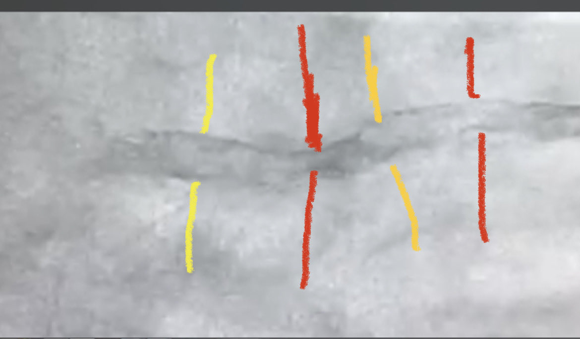 Hragy's tweet image. #CardioTwitter #FIT an example of a direct stent in a Calcific lesion that led to fatal outcome due to ST after 2 weeks,yellow lines show relatively well deployed segments,red lines show underdeployment.
⁦@DocSavageTJU⁩ gave a presentation on how to avoid this in #SCAI2022