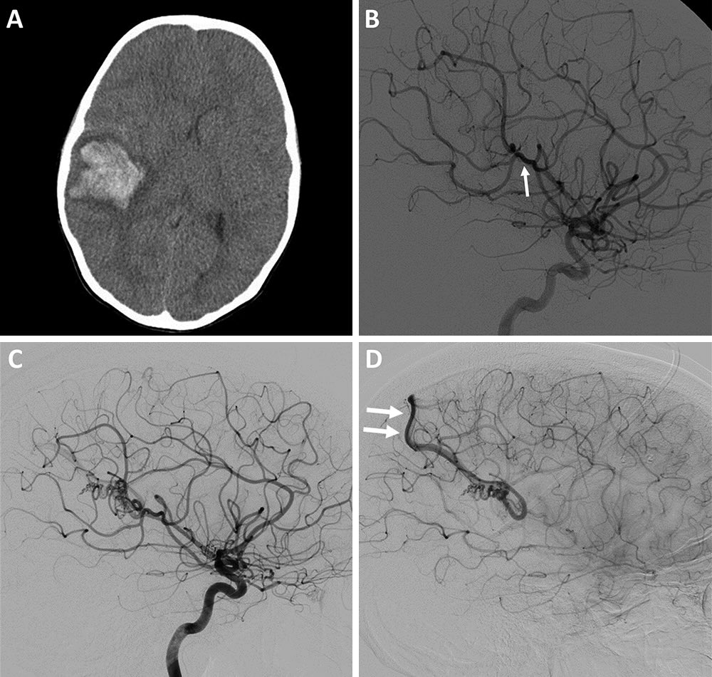 Gone today, but here tomorrow! Rare instances of bona fide recurrence of Pediatric AVMs after complete initial obliteration. Read about it in @TheJNS online first! bit.ly/3wOh0i0