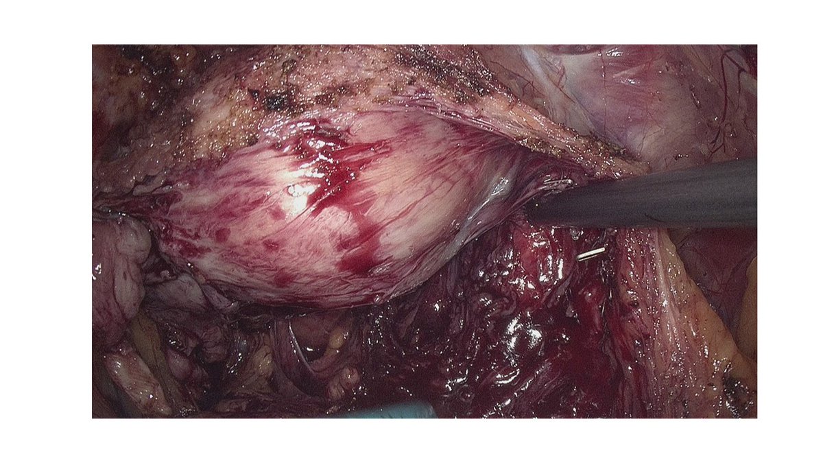 drmarcoscepeda's tweet photo. Happy to represent my team at #urotech22 with mini-ECIRS, upper calyx supine miniperc and laparoscopic radical prostatectomy with intrafascial NS. Congrats @AliSerdarGozen @SEITZ_C_C @drkemalsarica @AlbertoBreda1 for this fantastic meeting and thanks for the invitation! https://t.co/DgBJzh2bAc