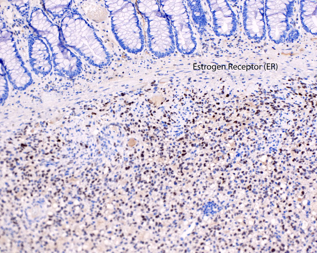 Low grade endometrial stromal sarcoma presenting as a colon polyp.  That lobulated appearance is a clue.