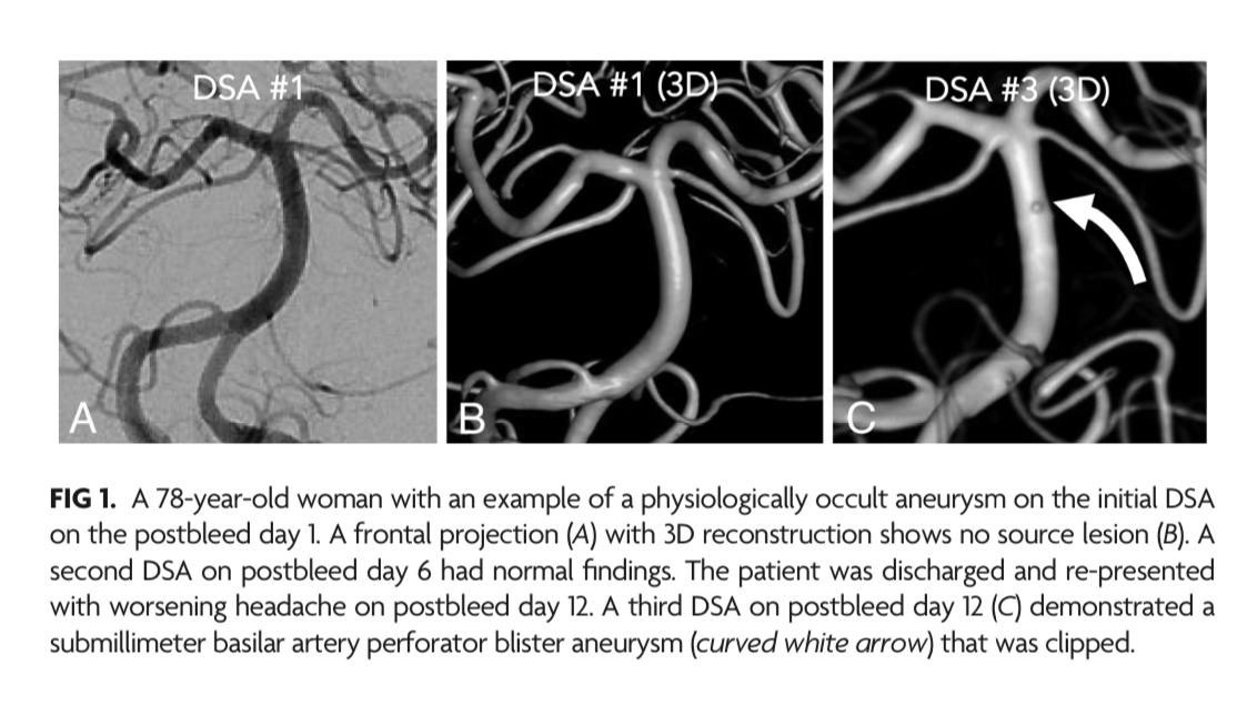 TheAJNR's tweet image. “Angiographically Occult Subarachnoid Hemorrhage: Yield of Repeat Angiography, Influence of Initial CT Bleed Pattern, and Sources of Diagnostic Error in 242 Consecutive Patients” #SAH @traviscaton @DanTonettiMD @UCSF_NIR @NeurosurgUCSF @neurores_ucsf | bit.ly/3NLj3KW