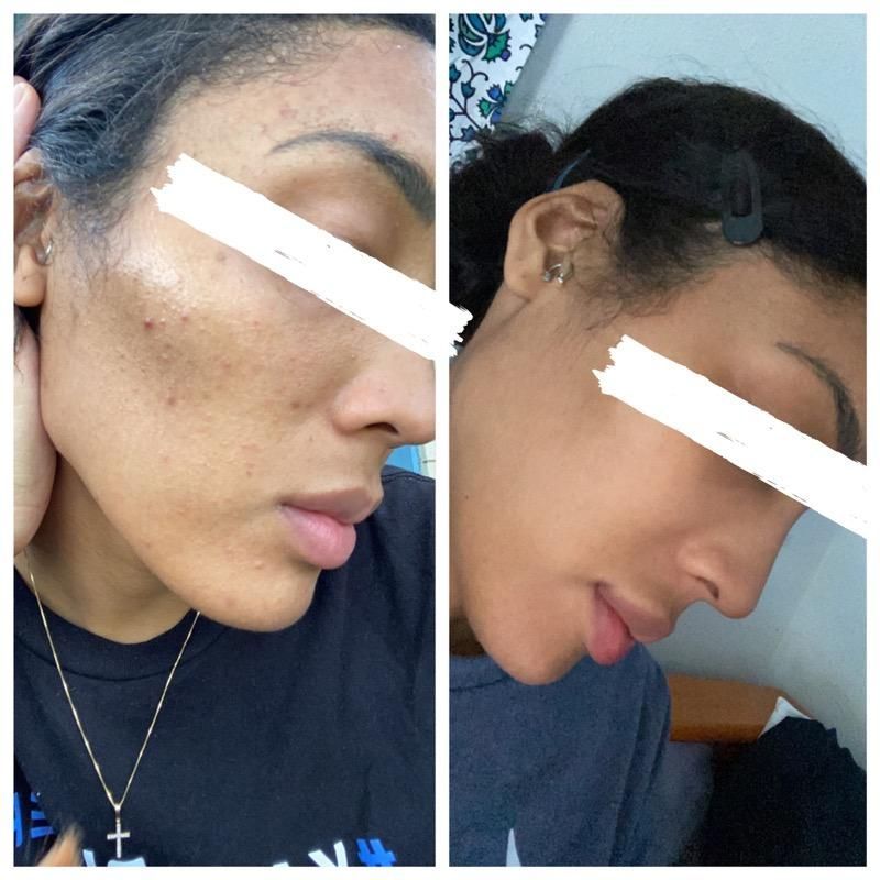 EnchantmentD's tweet photo. Memorial Day Sale starts now!!! - https://t.co/sdoadpbRfm 15% off with code "Memorial" Ends 5/31 Order now!
Tea Tree &amp; Activated Charcoal, great for oily/combination skin. Real results before &amp; after
#enchantmentessentials #shopnow #memorialdaysale #facialsoap #blackbusiness https://t.co/bZGu8b4NGA