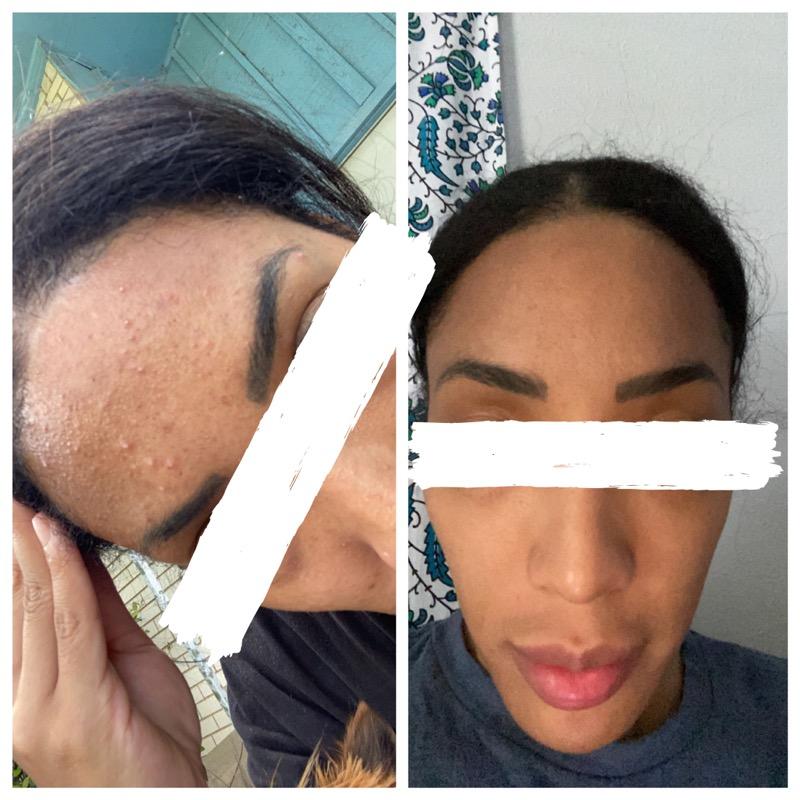 EnchantmentD's tweet photo. Memorial Day Sale starts now!!! - https://t.co/sdoadpbRfm 15% off with code "Memorial" Ends 5/31 Order now!
Tea Tree &amp; Activated Charcoal, great for oily/combination skin. Real results before &amp; after
#enchantmentessentials #shopnow #memorialdaysale #facialsoap #blackbusiness https://t.co/bZGu8b4NGA