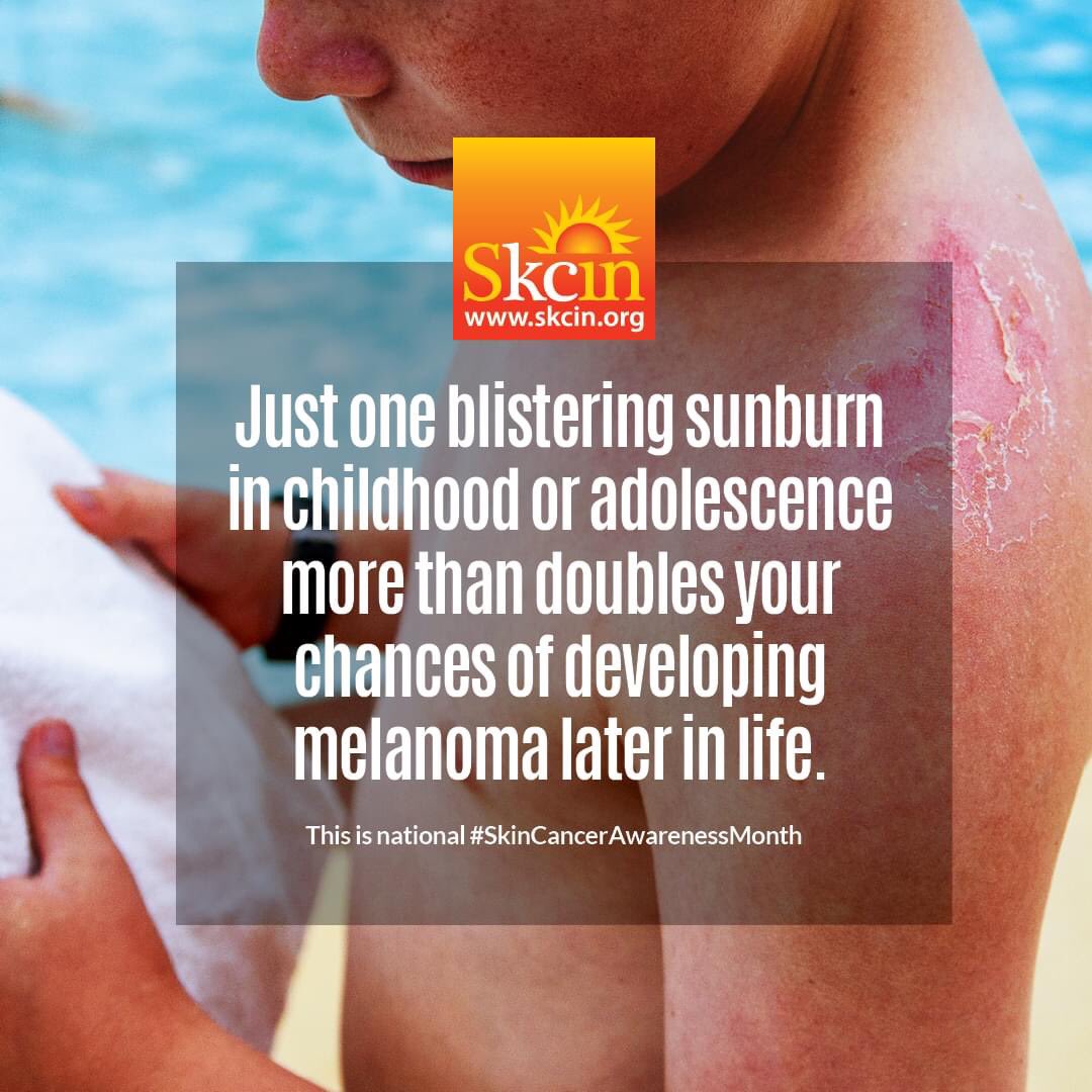 SkcinCharity's tweet photo. Ever had sunburn as a child or teenager? 

Many of us will have experienced sunburn in our younger years as the dangers of UV radiation and risk of skin cancer wasn’t fully understood or public knowledge until relatively recently. PREVENTION IS BETTER THAN CURE! https://t.co/nd0z0eEvjR