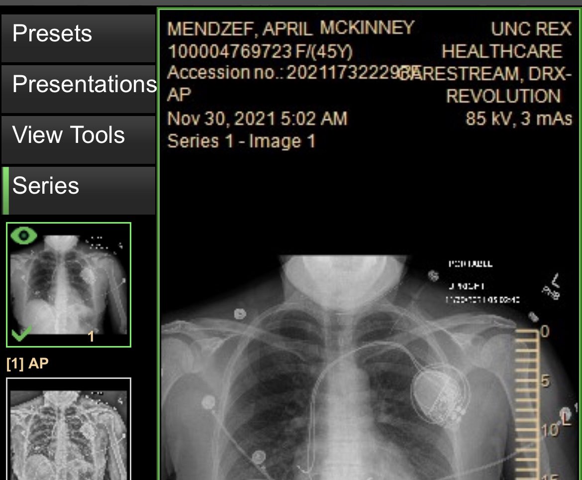 AprilMendzef's tweet photo. 6 months ago today I had a lifesaving pacemaker implant after suddenly developing a dangerous & potentially fatal cardiac arrhythmia at 45. It’s been a scary time for my family but I am so thankful for this amazing device and all it does for me. Make every day count! https://t.co/G2meoUGCDm