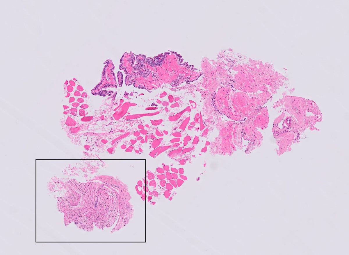 DrLaurenceGalea's tweet photo. Schmidt-Lanterman incisures evident in a myelinated nerve (prostatic core biopsy fragment)
First learnt about these clefts from our #PathTwitter friend @DrAldehyde 🙏https://t.co/Bx13eaWgoH
#NormalHistology #Pathology #PathResidents #GUPath https://t.co/luo0qS6uVe