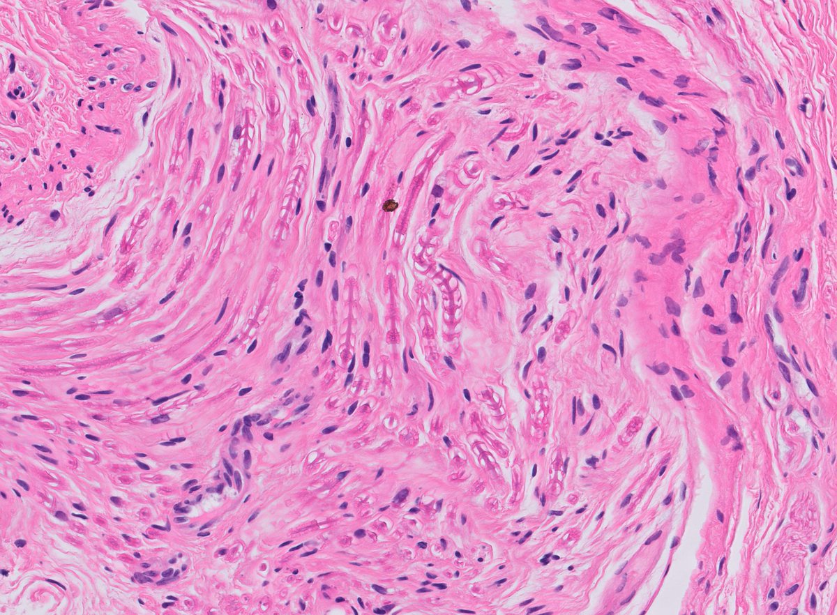 DrLaurenceGalea's tweet photo. Schmidt-Lanterman incisures evident in a myelinated nerve (prostatic core biopsy fragment)
First learnt about these clefts from our #PathTwitter friend @DrAldehyde 🙏https://t.co/Bx13eaWgoH
#NormalHistology #Pathology #PathResidents #GUPath https://t.co/luo0qS6uVe