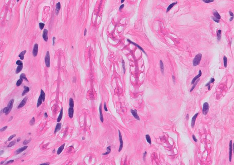 DrLaurenceGalea's tweet photo. Schmidt-Lanterman incisures evident in a myelinated nerve (prostatic core biopsy fragment)
First learnt about these clefts from our #PathTwitter friend @DrAldehyde 🙏https://t.co/Bx13eaWgoH
#NormalHistology #Pathology #PathResidents #GUPath https://t.co/luo0qS6uVe