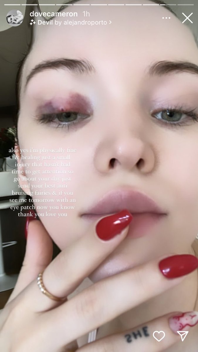 Now how does she still look flawless with her hurt eye. Love u and hope u get better tho <a href="/DoveCameron/">Dove Cameron</a> #dovecameron #flawless