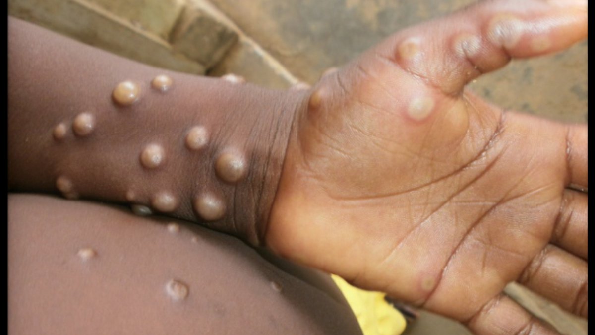 immuninfection's tweet photo. VIRUELA DE LOS MONOS o MONKEYPOX
- Descrita recientemente en Europa (España está a la espera de confirmación de varios casos), es una zoonosis que ocurre esporádicamente en zonas remotas del centro y oeste de África.

Abro hilo... https://t.co/eq7bK9RXid