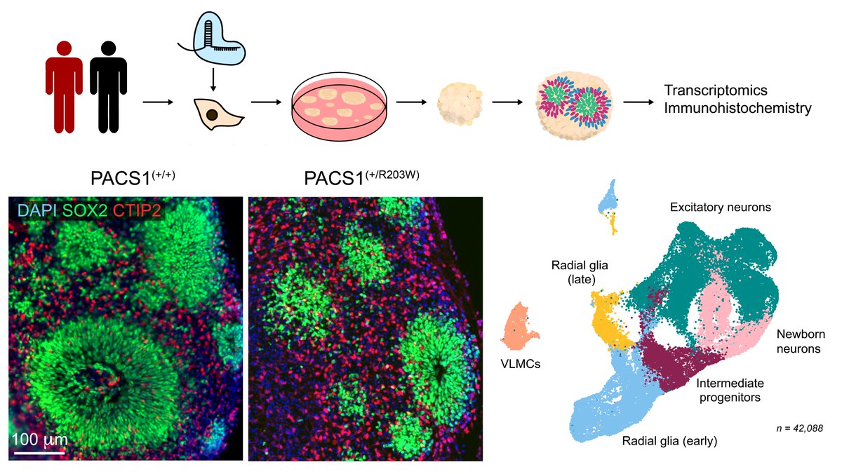 L_Rylaarsdam's tweet photo. Methods: To look at the impact of this variant on the developing brain, we differentiated patient and control induced pluripotent #stemcells to cerebral #organoids and then did #singlecellRNAsequencing. This allowed us to look at disease mechanisms in distinct neural cell types. https://t.co/dF8ZNEBWcS
