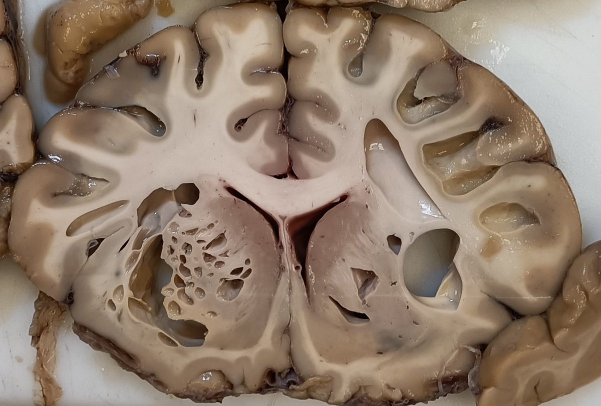 Formalin fixed brain from an #autopsy case. But not to panic! This spongy look is actually what kind of finding? (And note, the decedent didn't eat a CJD contaminated hamburger either)