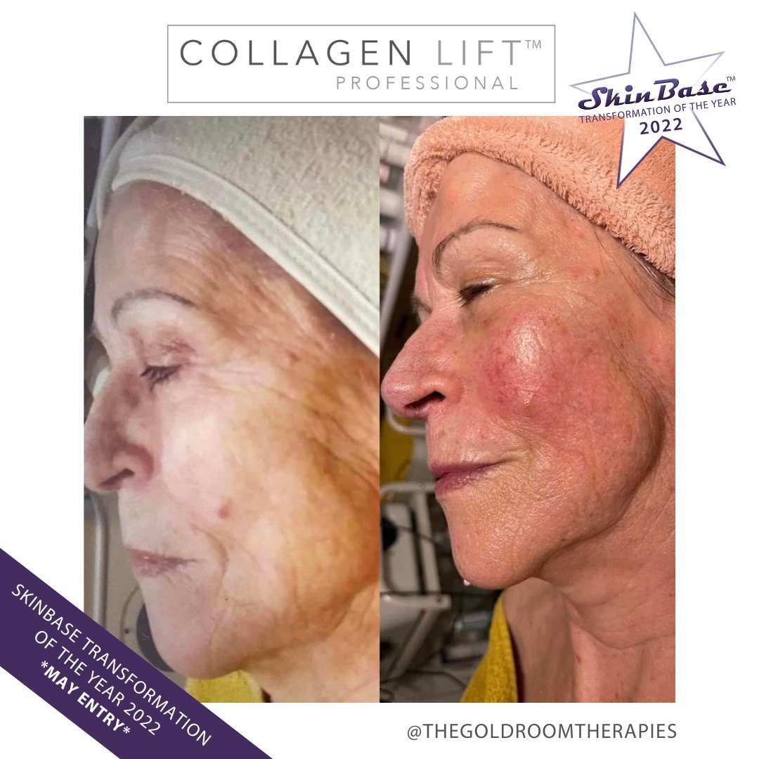 SkinBase_facial's tweet image. ⭐️ May transformation with this fabulous entry from The Gold Room Therapies. These fantastic results were achieved through a 6 treatment course of Collagen Lift.  

Click the link in our bio for your chance to Win a Holiday! #skinbase #collagenlift #transformation22