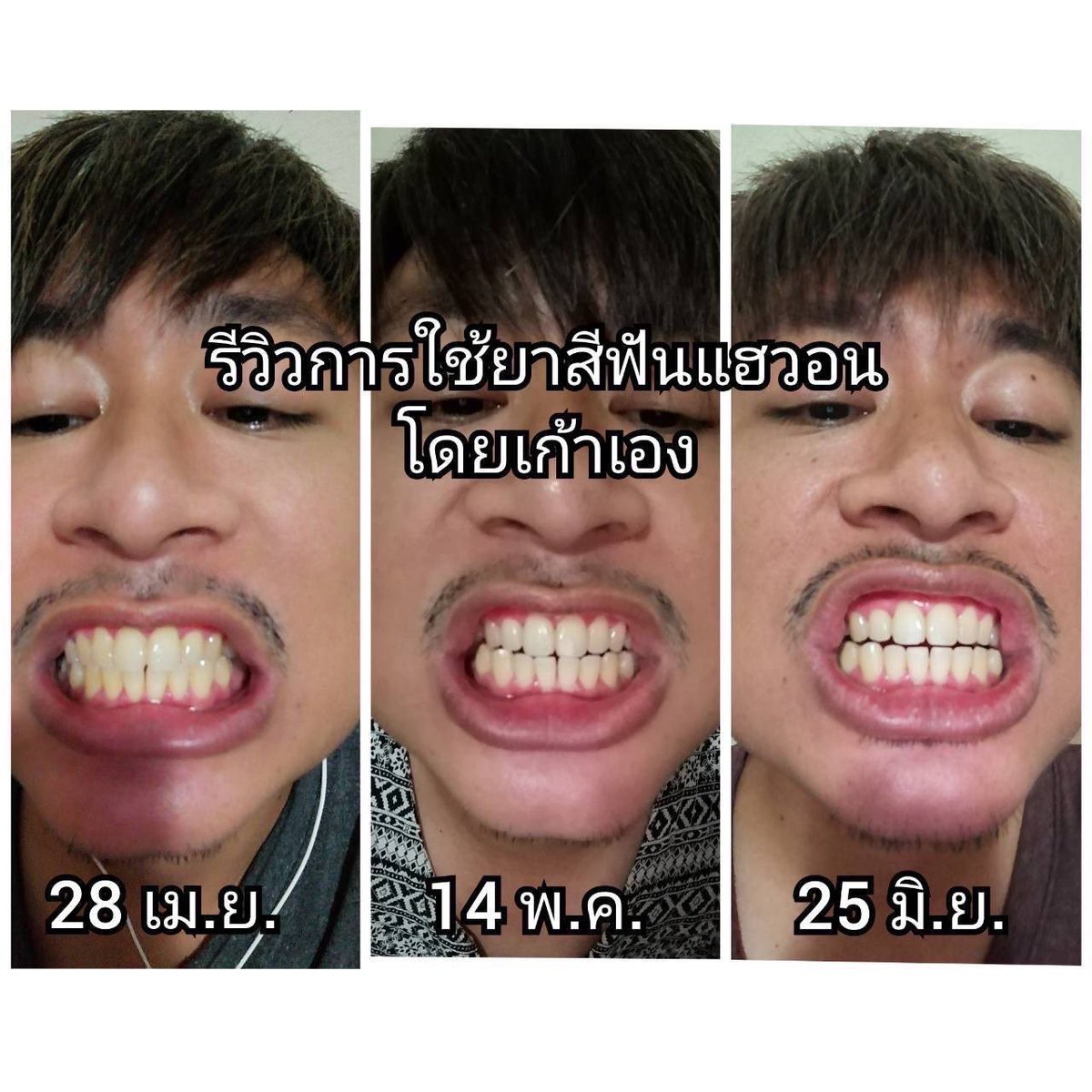 SkinMook's tweet photo. ขอคนละ1รี บอกบุญคนอยากฟันขาว 
สำหรับคนที่จัดฟัน ฟันเป็นคราบเหลือง สียางซีด มีกลิ่นปาก ต้องลองเลยค่าา #ของมันต้องมี #ยาสีฟันแฮวอน
พิกัด📍 https://t.co/VPKBcy06TH https://t.co/sevnZ4Z4x7