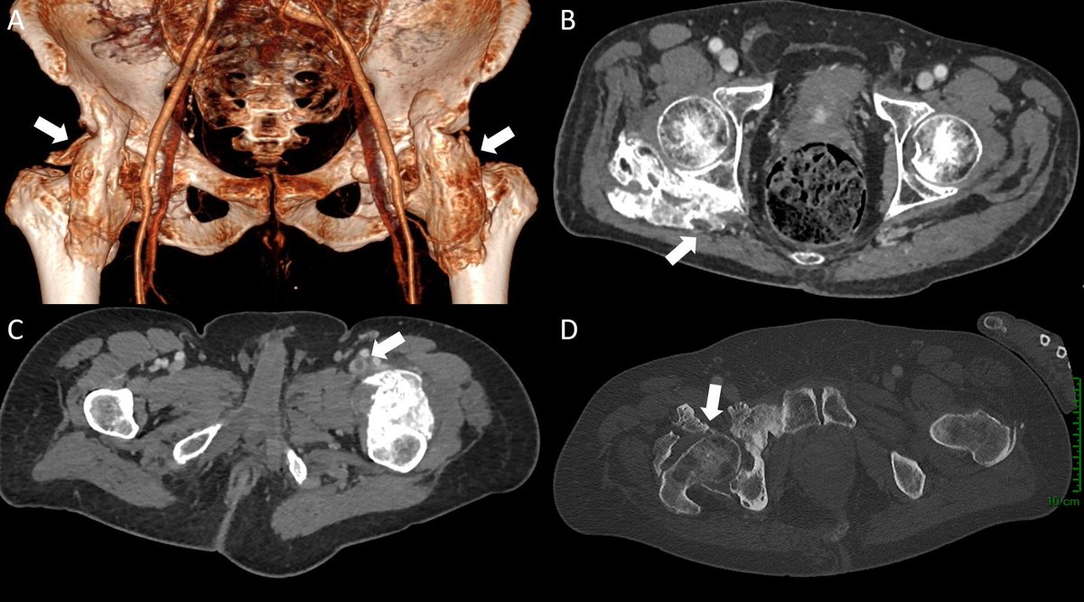 Heterotopic ossification and COVID 19: Imaging analysis of ten consecutive cases published in EJR @ELS_Radiology sciencedirect.com/science/articl…