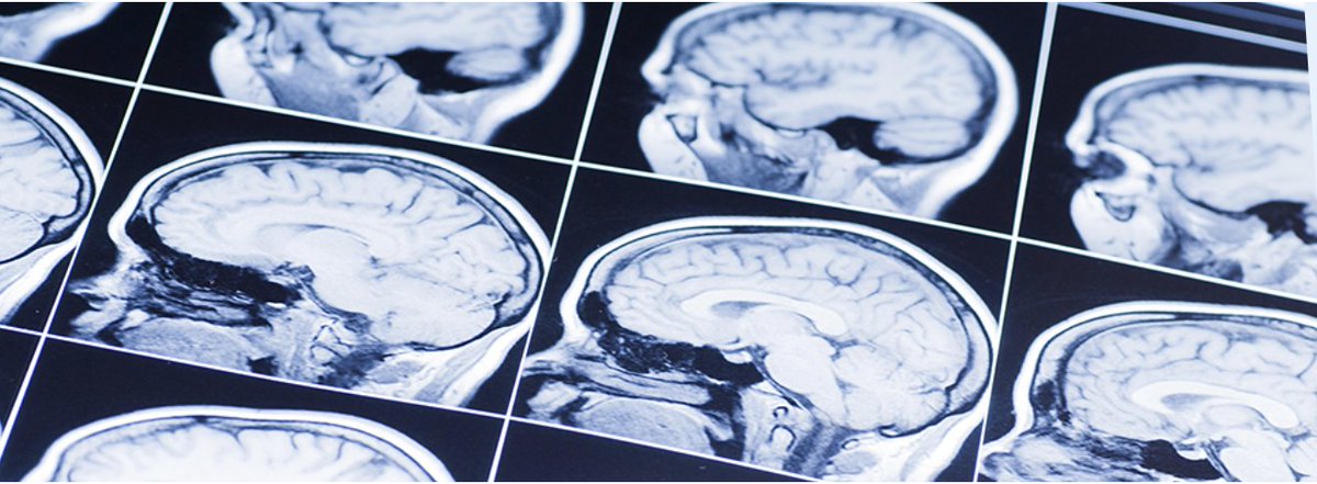 ContentGeneMD's tweet photo. Mesenchymal stem cell therapy for focal #epilepsy: A systematic review of preclinical models and clinical studies

To access the FULL TEXT for FREE, register here:
https://t.co/rfLQHU6oaQ

#biologics #clinicaltrial #humanstudy #stemcells #Neurology https://t.co/whl5d0CCBy