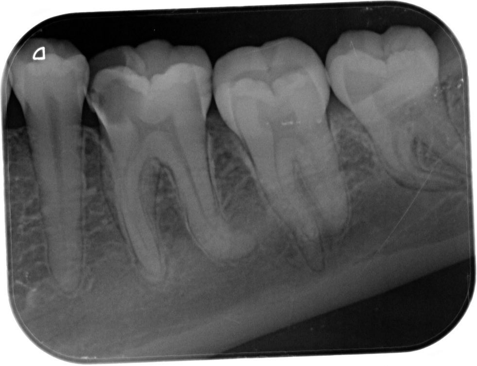 MgDent's tweet photo. SIP/NAP 
Lower 6/4 canals 
DB canal curveture
MB+ ML canal Calcified in apical third .
BC sealer + single cone 
TF https://t.co/x4ixygIqnN