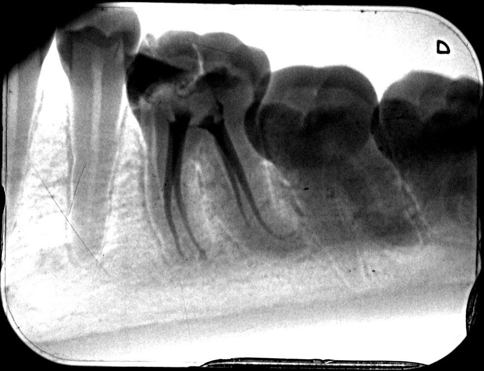 MgDent's tweet photo. SIP/NAP 
Lower 6/4 canals 
DB canal curveture
MB+ ML canal Calcified in apical third .
BC sealer + single cone 
TF https://t.co/x4ixygIqnN