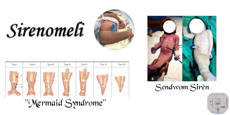 Docteur_Perrin's tweet photo. #28
Alo Dòk La 

Sirenomeli 
Yo rele l tou "Mermaid syndrome" ou  "sendwom  sirèn" kote bebe a gen  tout manm pa anba yo ki kole. Jiskaprezan lasyans poko ka jwenn koz egzat li. E bebe sa a kapab gen defòmasyon tou nan ren l yo, nan pati jenital yo, zo do l ouswa nan poumon. https://t.co/6XSpwrGeA2