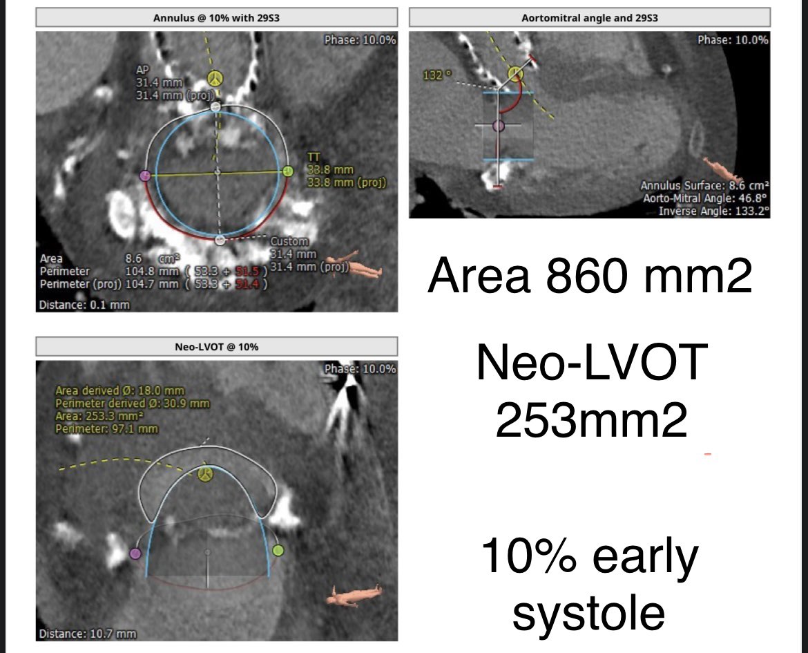 GilbertTangMD's tweet photo. #VIMAC #TMVR extreme risk case borderline neo-LVOT 145mm2 area 860mm2. Early mid systole >200mm2. Doable (-) LAMPOON? Can’t ASA. @CathElectroSurg @bapat_savrtavr @igeorge1975 @OKhaliqueMD @JoaoLCavalcante @AdamGreenbaumMD @fjsawaya @mirvatalasnag @KendraGrubb @KHERA_MD https://t.co/FBjzySa8rl
