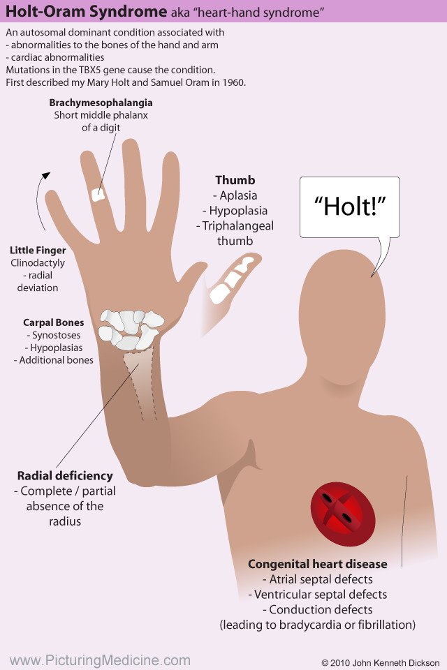 mhjrad's tweet photo. Holt-Oram syndrome is characterized by skeletal abnormalities of the hands &amp; arms and cardiac defects. 

Patients classically present with abnormal carpal bones, thumb abnormalities, underdevelopment/absence of the radius, and ASD/VSD, but presentation varies greatly. https://t.co/7wSFa9CY5y