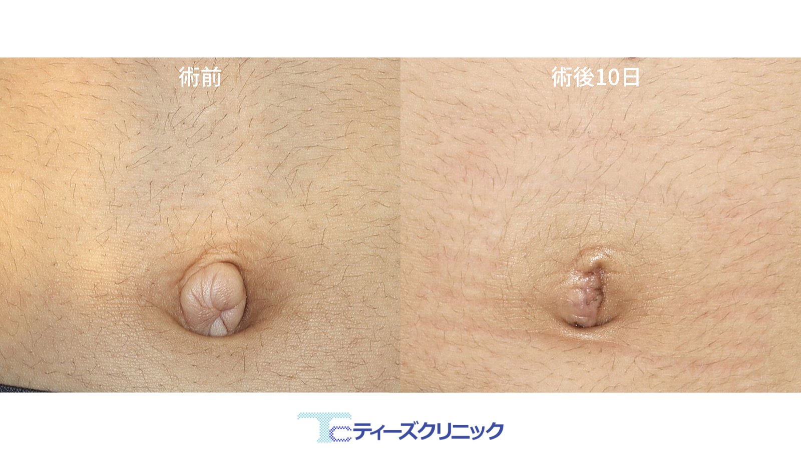 ティーズクリニック 東京都墨田区 形成外科 美容外科 10代男性 赤ちゃん の頃からのでべそは時間の経過でほとんどの場合はでべそでなくなりますが こちらの方は大学生になってもへそが飛び出しています コンプレックスで友達とプールや温泉に行くのが