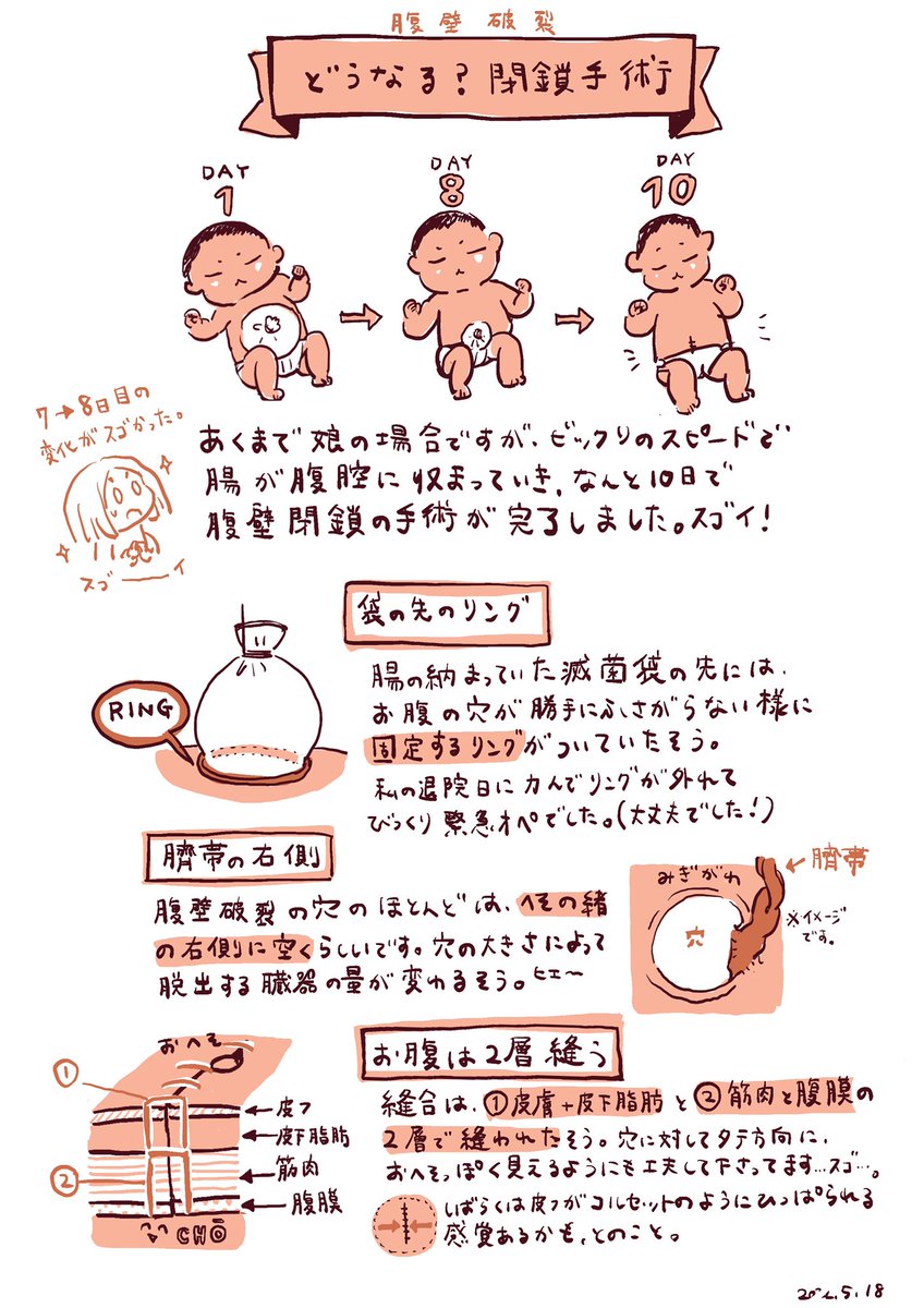 腸が入り切って、お腹の穴を閉じる、腹壁閉鎖の手術まで。ちょっとトラブルはあったものの、無事に閉じられました!
手術に備え伺った細かな諸々を描きました。治療自体はまだまだこれからですが、とりあえず大きな進展!力まずいてほしいな。
穴の大きさは約8cmくらい。治療ありがとうございます😭