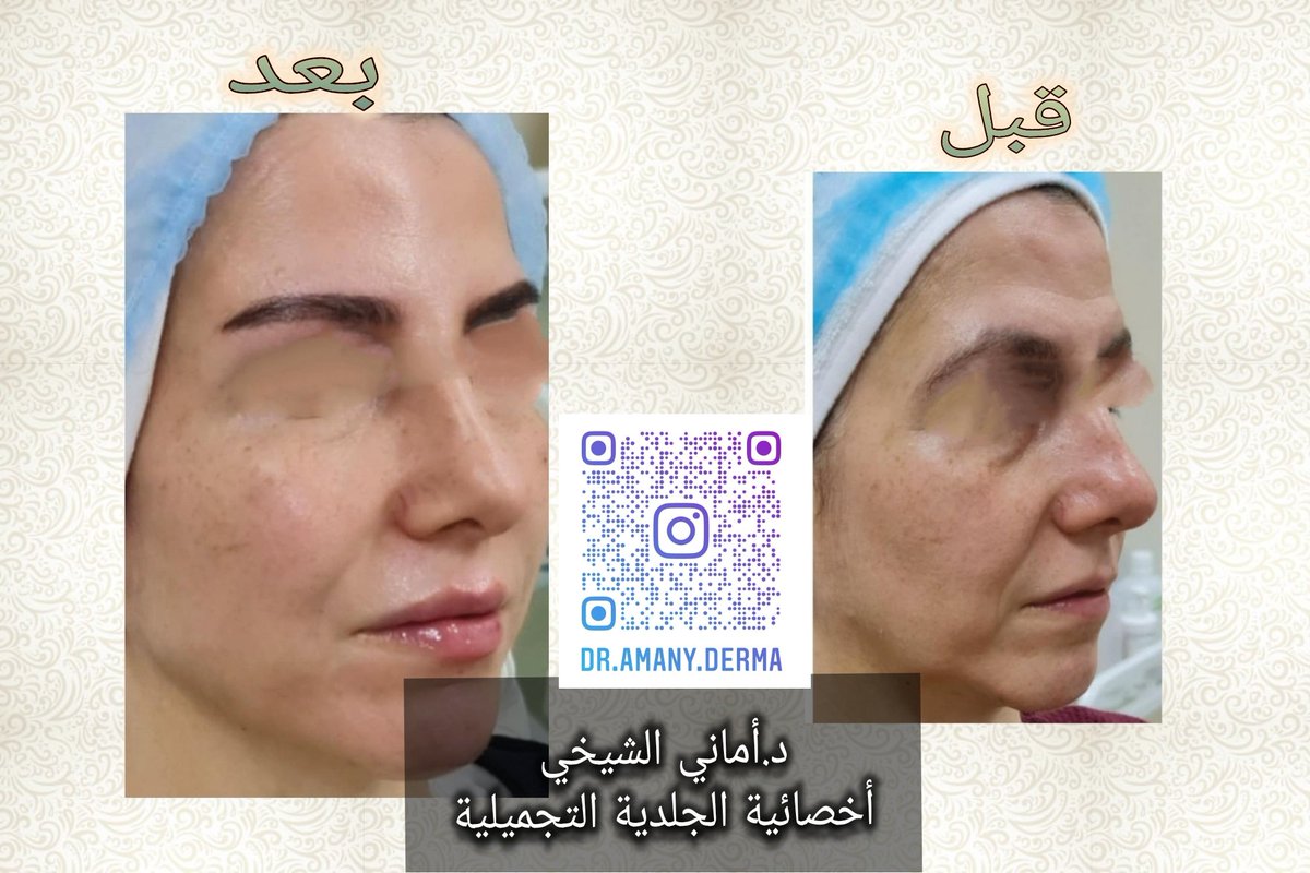 Dramanyderma's tweet photo. جلسات إعادة الشباب 😍
#تجميل #بنغازي #ليبيا https://t.co/l2dy3zEsKe