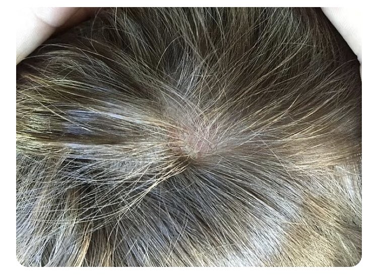 shelldanorissa's tweet image. I HAVE A HUGE PROBLEM WITH THE WHOLE HAIR THING.. HOW IS IT POSSIBLE THE SHORT ALMOST UNHUMAN LOOKING HAIR CAME FROM THE TOP OF THE SCALP? LOOKS LIKE PSORIASIS.. DOES SHE WEAR EXTENTIONS? @courttv @juliegrant #JusticeForJohnnyDeep