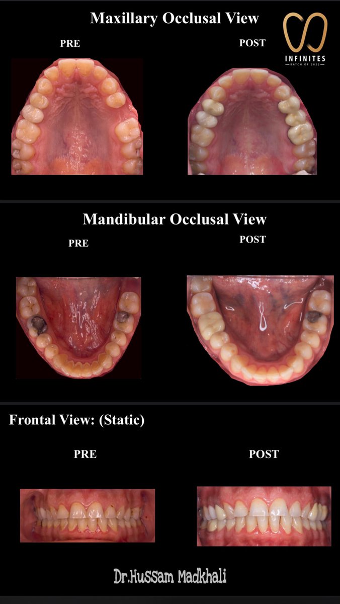 من الحالات اللي خلصتها في عيادات العلاج الشامل ( CCC ) 🎓✨ 

١- تنظيف وعلاج اللثة والانسجة المحيطة.
٢- علاج عصب ثم وتد وتركيبة ثابتة لضرس في الفك السفلي.
٣- ازالة التسوسات ووضع حشوات تجميلية.
٤- تركيبات ثابتة.
#infinites2022