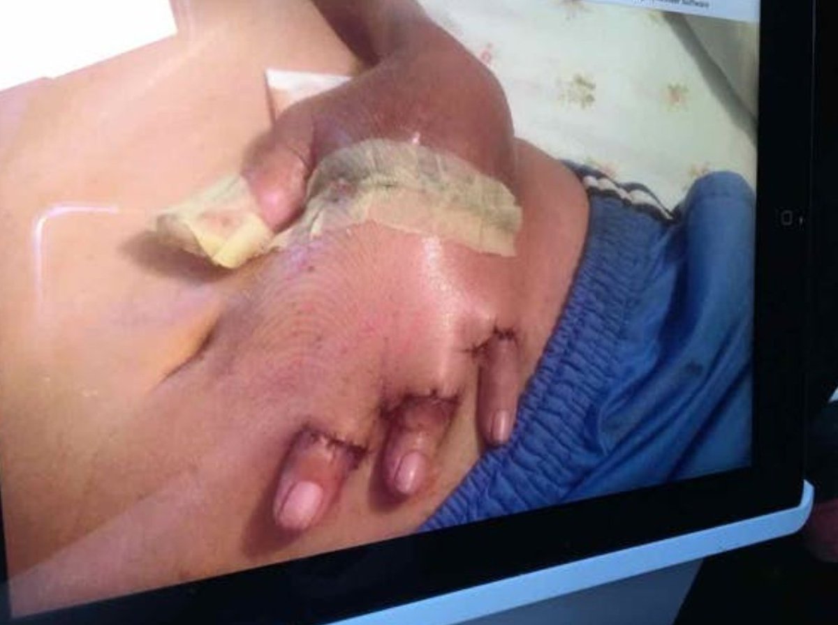 La imagen clínica de <a href="/Figure1/">Figure 1</a>: un colgajo abdominal pediculado para cubrir una quemadura en el dorso de la mano. #Cirugía #Cirujanos
