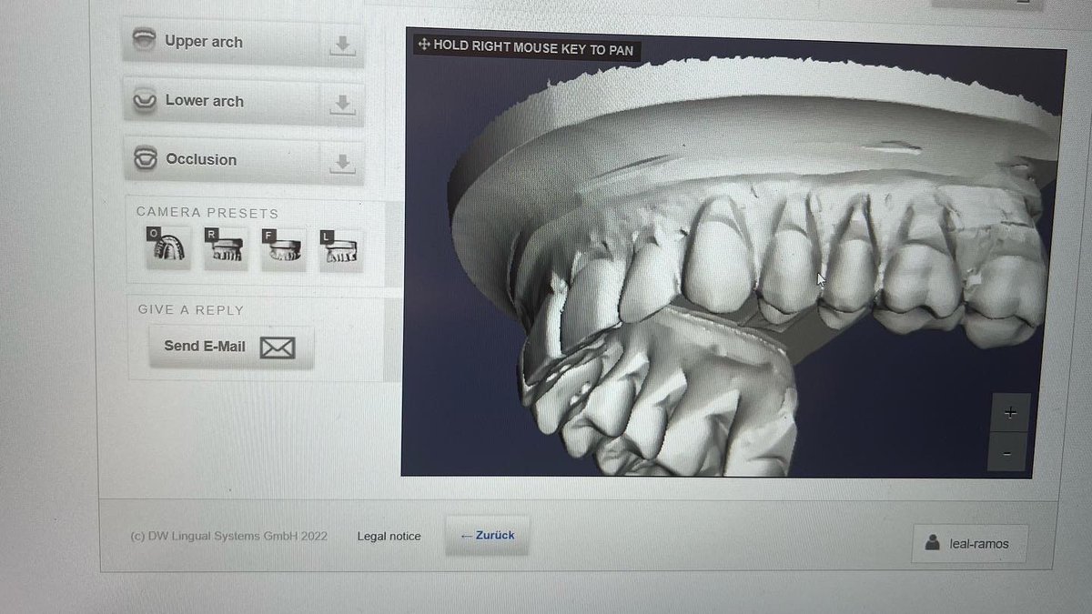 thaislealramos's tweet image. Hoy revisando casos de la Ortodoncia Lingual WIN, para después proceder cuanto antes a la fabricación de la aparatología en el laboratorio de Alemania. 

#ortodonciatenerife #ortodoncialingualtenerife #winlingualbraces #movetowin #ortodonciainvisibletenerife