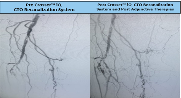 Todd_BDPI's tweet photo. 40cm CTO w/ 30° angle, distal popliteal lesion. Crossed using #CrosseriQ catheter and observed a 1 min 21 sec activation time. Great results @ehrin_armstrong. #CrossThisFast
For use in peripheral artery CTOs; Not for use in carotid arteries. Safety info: https://t.co/4MNnY7FOvI https://t.co/9rW8mmp7tj