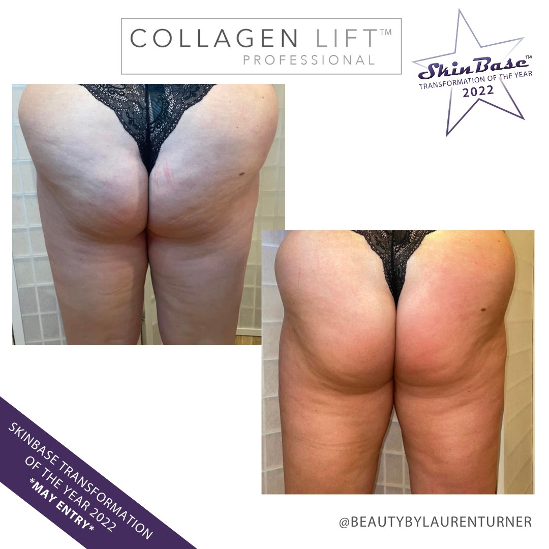 SkinBase_facial's tweet image. ⭐️ May transformation with this fabulous entry from Beauty By Lauren Turner. These fantastic results were achieved through a 6 treatment course of *Collagen Lift.  

Click the link in our bio for your chance to Win a Holiday! #skinbase #collagenlift #transformation22