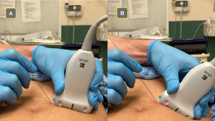 Simple tip for improving needle visualization when performing blocks. acepnow.com/article/tips-f… <a href="/HGHED/">Highland EM</a> <a href="/ACEP_EUS/">ACEP Ultrasound</a> #EMin22