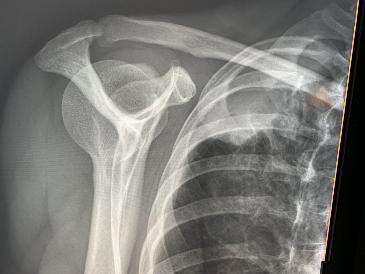 northwoods1980's tweet photo. Orthopedic clinic. 43-year-old female with right shoulder pain. What do we think?🙈 https://t.co/YUs7LfYg5D