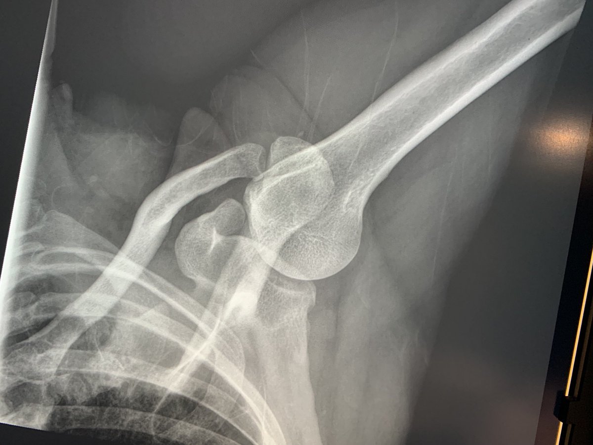 northwoods1980's tweet photo. Orthopedic clinic. 43-year-old female with right shoulder pain. What do we think?🙈 https://t.co/YUs7LfYg5D
