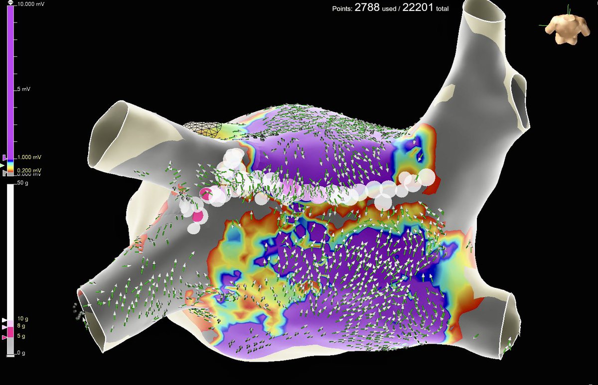 PorrelloSarah's tweet photo. RF lesion set and omnipolar arrows demonstrating roof block post ablation. Full color propagation below. (2/3) https://t.co/UXwv6qzi7T