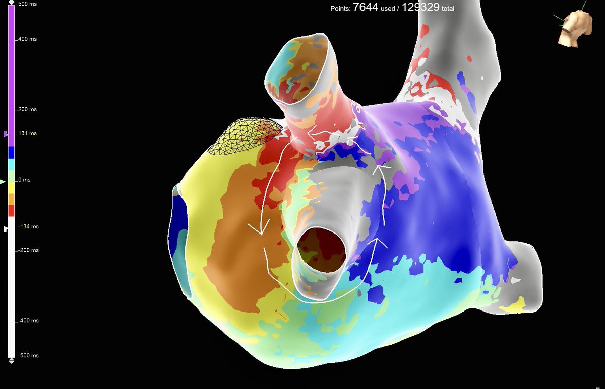 PorrelloSarah's tweet photo. Post-cryo AAFL mapped using #HDGrid on #EnsiteX
Loved the clear omnipolar arrows showing a gap in the LSPV, and later demonstrating roof block (below). A very satisfying and efficient case performed by @NiutonSKoide! (1/3) https://t.co/VVquki8dxn