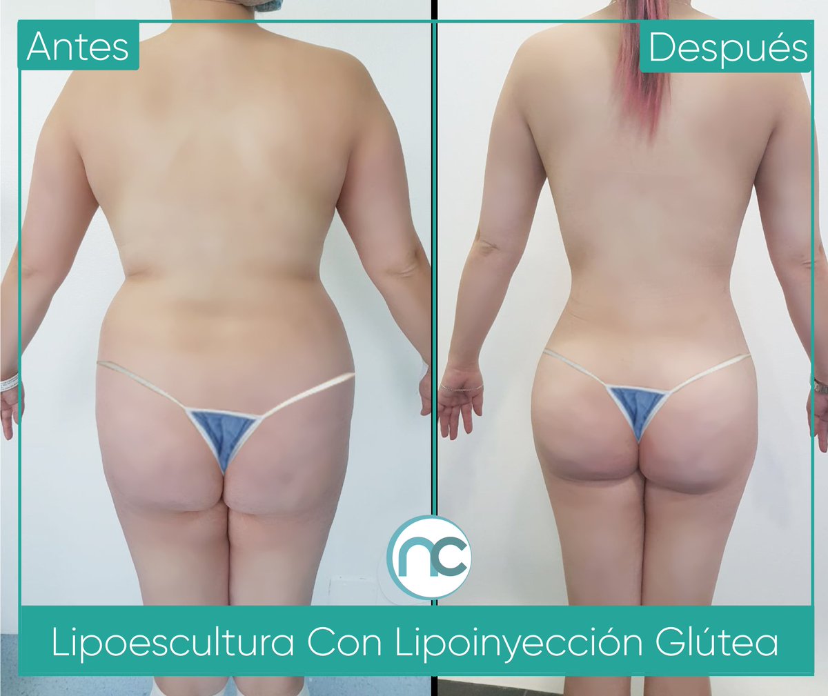 drnelsonchaves's tweet photo. 👨🏻‍⚕️ En esta imagen puedes observar el resultado de una paciente, a quien le realicé una Liposucción más LipoInyección glútea ✔

👉 🥗 Recuerda mantener una dieta saludable y 🏃🏻‍♀️🧘🏻‍♀️rutina de deporte para sacar el máximo provecho a su nueva figura. 🥰 https://t.co/cxmftAJgNi