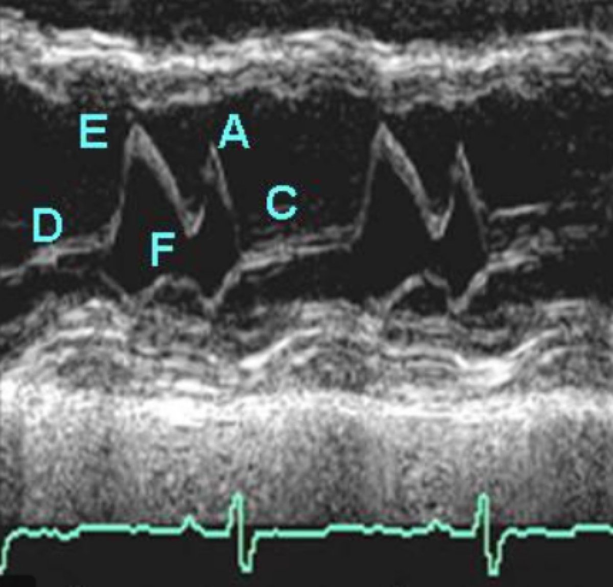 Arafatmahmoud's tweet image. Anterior Mitral Valve M-mode points for 
#firstecho  
D: End systole
E: Early opening
F: Mid-diastolic Closure
A: Atrial Systole
C: Closure