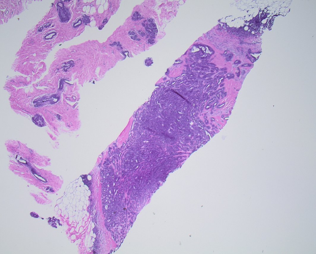 mhassanaimc's tweet photo. 2 cm enhancing mass in breast of 60/F. The excision has similar findings. What is the diagnosis? #breastpath https://t.co/GGBCPW1et9