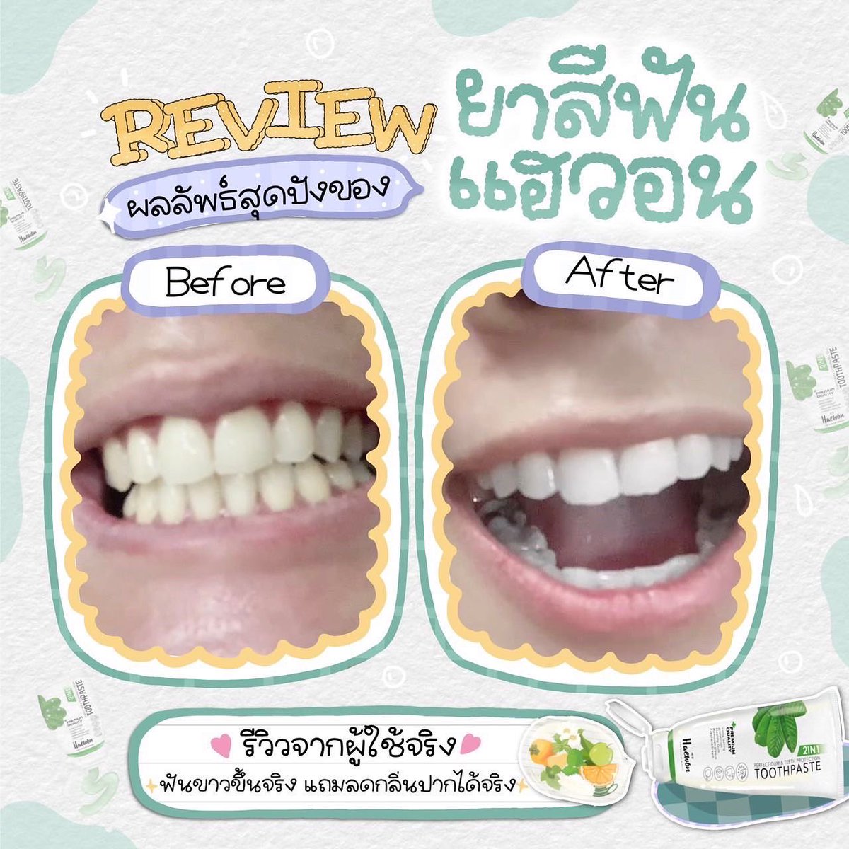 SkinMook's tweet photo. ไม่แปลกใจเลยว่าทำไมถึงขายดี💕
รีวิวผลลัพธ์จากผู้ใช้จริงปังมากก
ฟันขาวขึ้นแถมช่วยลดกลิ่นปากได้ดีมากด้วยค่าา🥰#ป๊ายปายโอริโอ้ #dek65 #น้ําท่วม #หาแฟนเป็นอาร์มี่ https://t.co/lUDopLIaTE