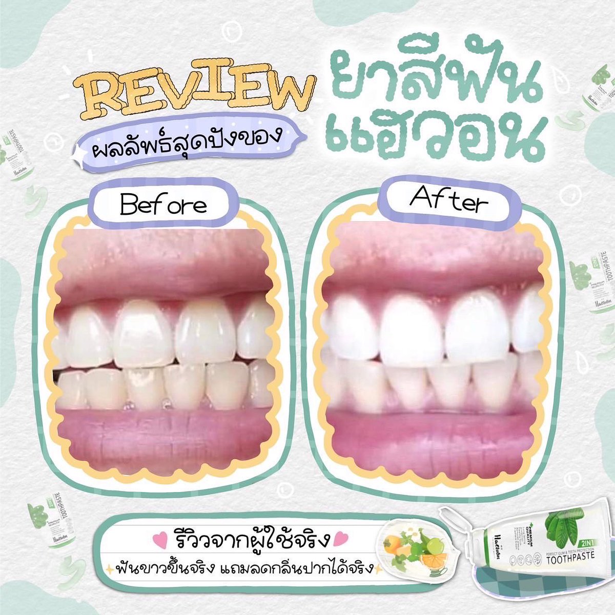 SkinMook's tweet photo. ไม่แปลกใจเลยว่าทำไมถึงขายดี💕
รีวิวผลลัพธ์จากผู้ใช้จริงปังมากก
ฟันขาวขึ้นแถมช่วยลดกลิ่นปากได้ดีมากด้วยค่าา🥰#ป๊ายปายโอริโอ้ #dek65 #น้ําท่วม #หาแฟนเป็นอาร์มี่ https://t.co/lUDopLIaTE