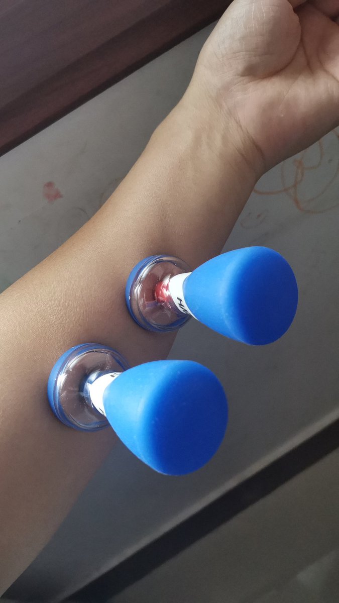 Johnny_Chu2018's tweet image. HACI Cupping treatment !!